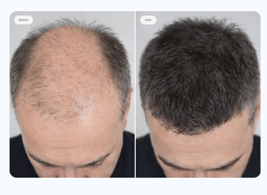 Red Light Therapy Hair Growth Cap – 660nm & 850nm Scalp Regrowth Device | Rayvva
